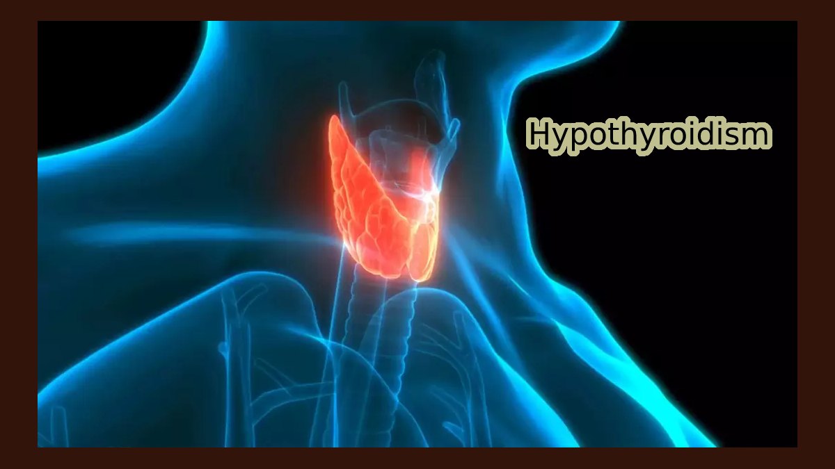 Hypothyroidism: what is it, symptoms and treatment