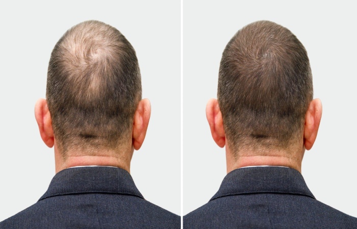 Hair Transplant Write For Us